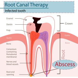 Choose A Dentist Who Can Help You With an Abscessed Tooth 1 An Abscessed Tooth