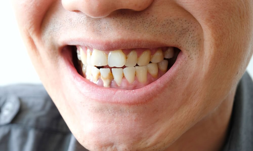 Choose A Dentist Who Offers Calcium Phosphate Materials in Dentistry 130 Calcium Phosphate Materials in Dentistry