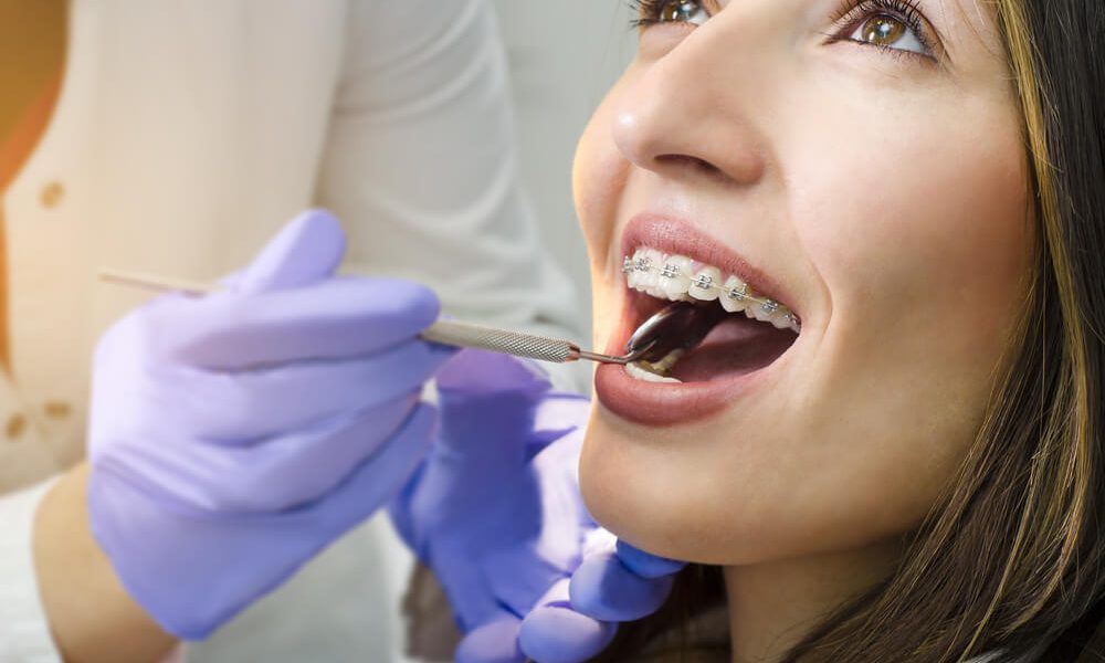 Best Dental Braces - Dentist Who Offers Dental Braces 137 Dental Braces