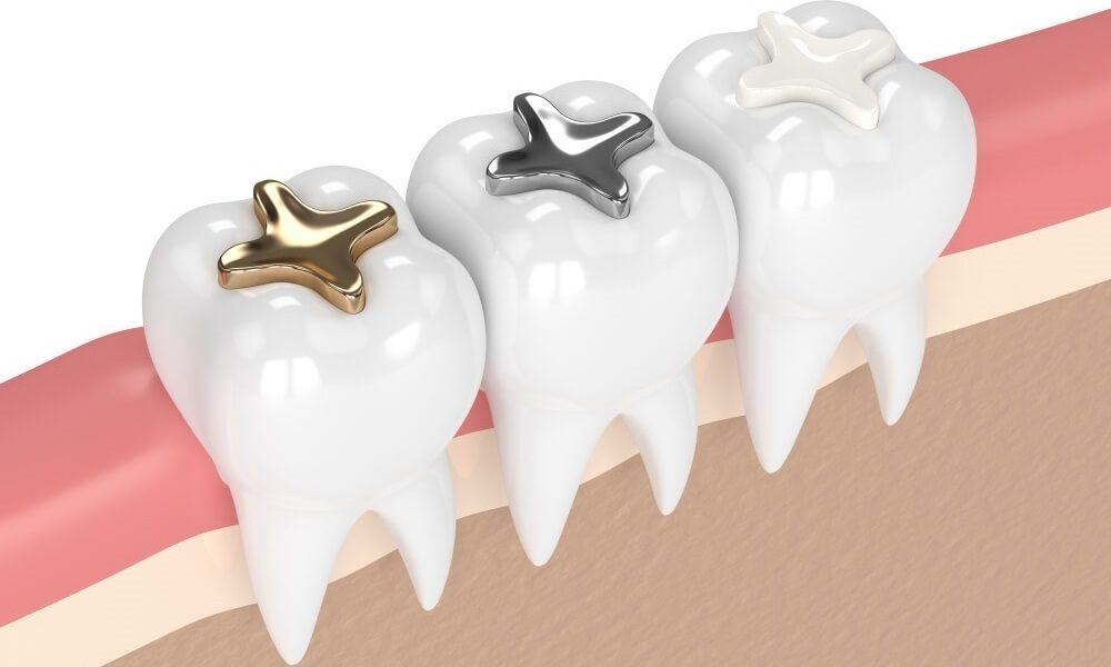 Choose a Dentist Who Offers Dental Fillings 92 Dental Fillings Types