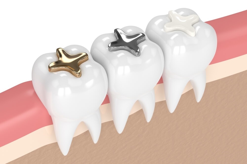 Choose a Dentist Who Offers Dental Fillings 1 Dental Fillings Types