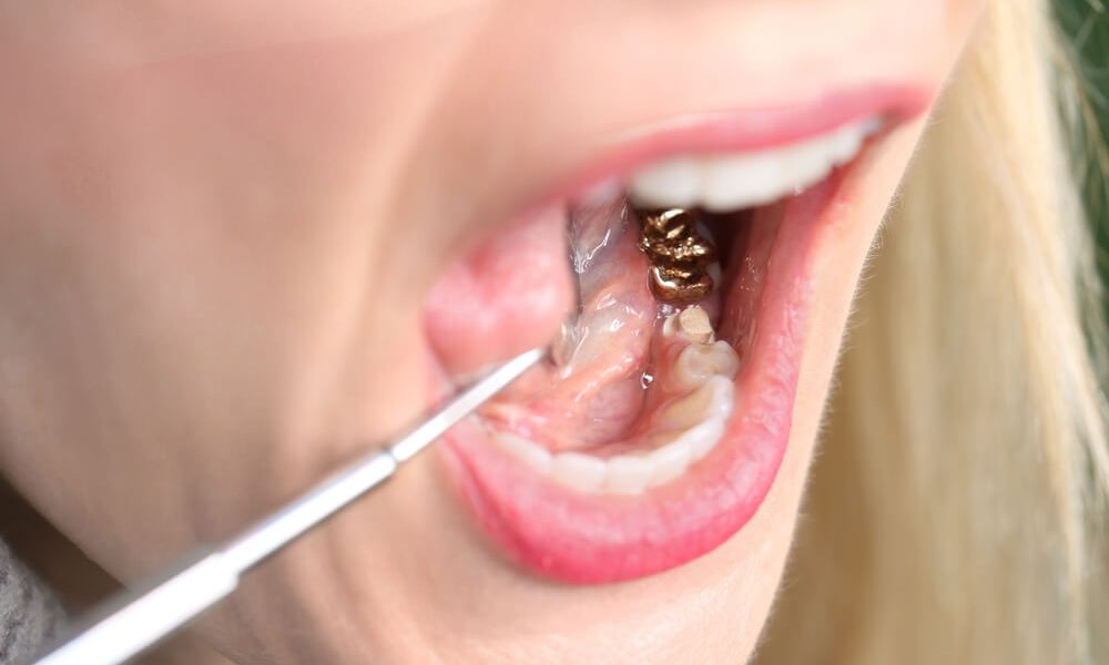 What You Need to Know About Dental Gold and Grills (Grillz) 82 Dental Gold and Grills (Grillz)