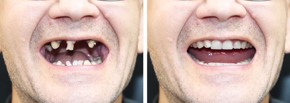 Choose A Dentist Who Offers Dental Implants and Mini-Implants 2 Dental Implants Before and After