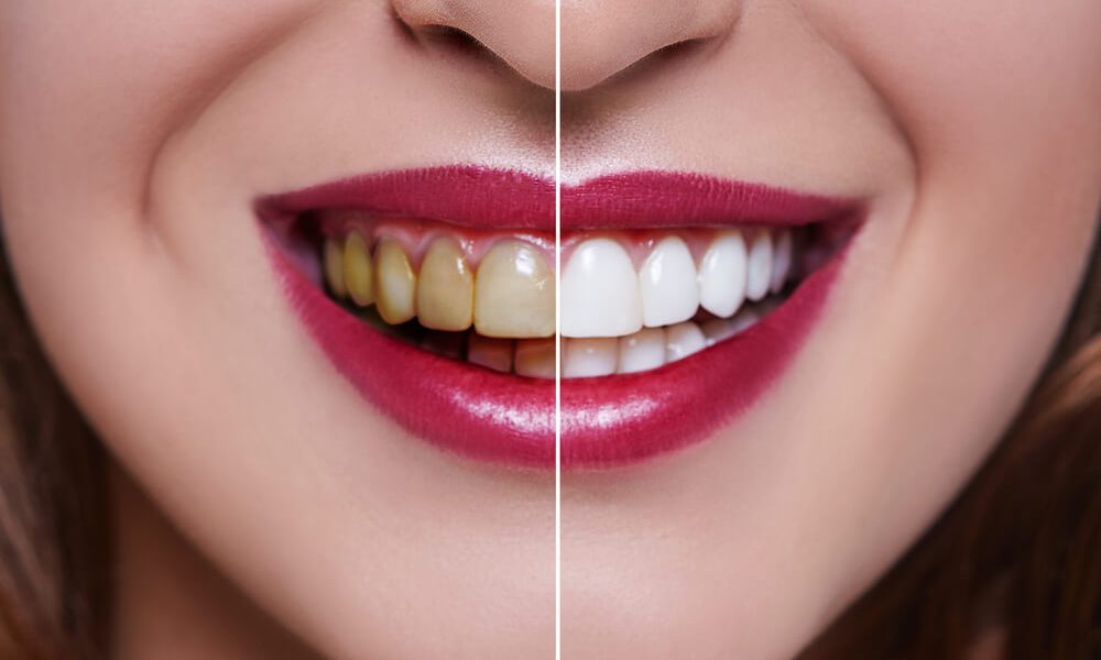 Dental Veneers
