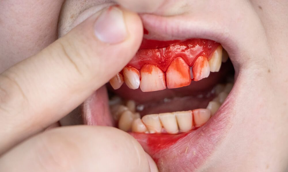Fight Gum Disease - How To Treat Gum Disease? 205 Fight Gum Disease