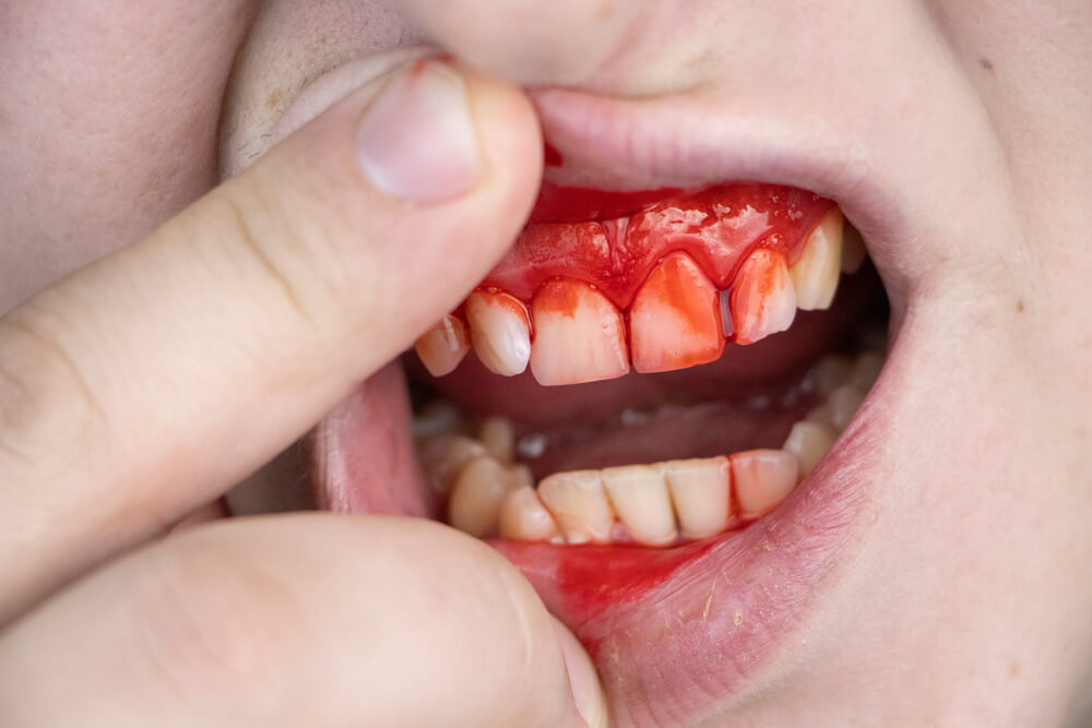 Fight Gum Disease - How To Treat Gum Disease? 1 Fight Gum Disease