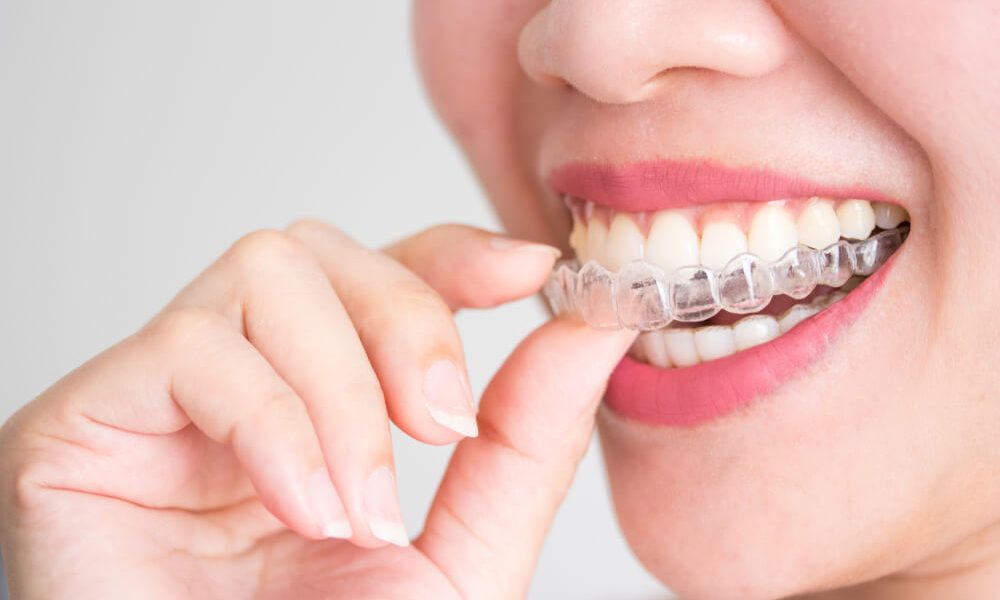 Choose A Dentist Who Offers Invisalign Treatment 39 Invisalign Treatment