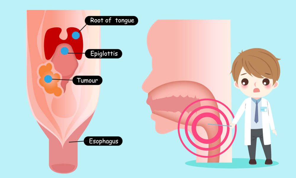 Oral Cancer - Choose A Dentist Help You with Mouth Cancer 174 Oral Cancer Symptoms