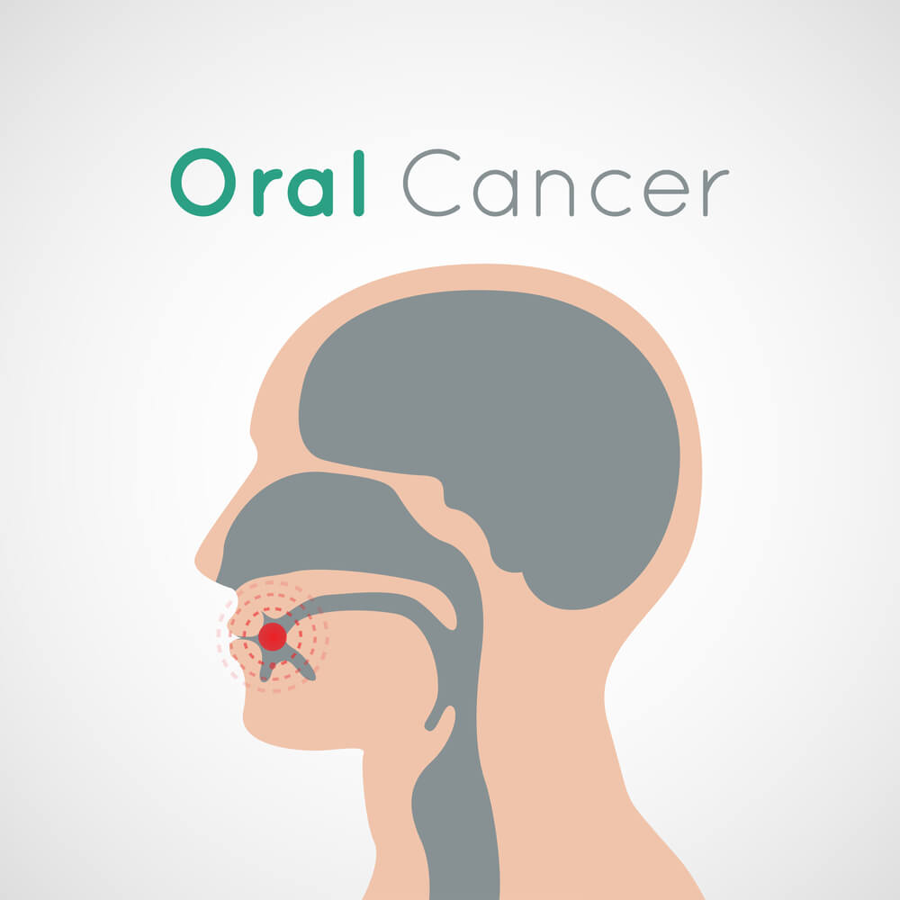 Oral Cancer - Choose A Dentist Help You with Mouth Cancer 4 Oral Cancer