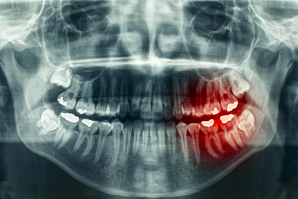 Panoramic Dental X-ray