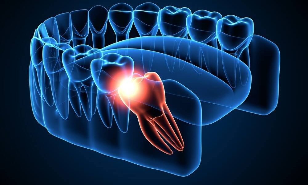 Wisdom Teeth Issues - Symptoms, Signs, Removal, Recovery 148 Wisdom Teeth Issues
