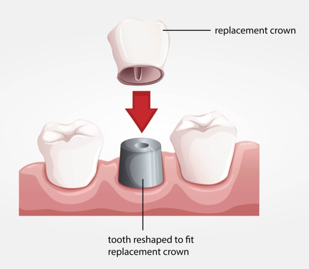 Signs That You May Need To Get a Dental Filling Replacement 13 Dental Filling Replacement